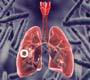 Tuberculose provoca uma em cada três mortes relacionadas à AIDS no mundo