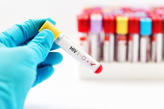 HIV: quando fazer o exame?